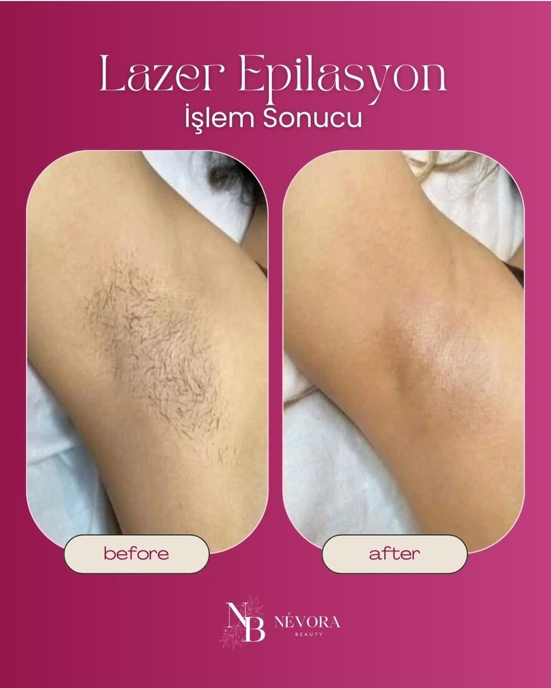Lazer Epilasyon – Kalıcı & Etkili Çözüm